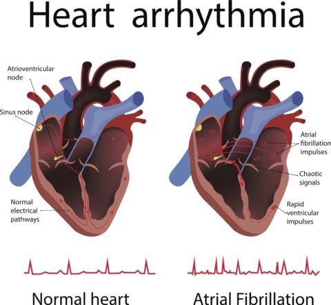 Electrophysiology study: what you need to know | Eastern Heart Clinic