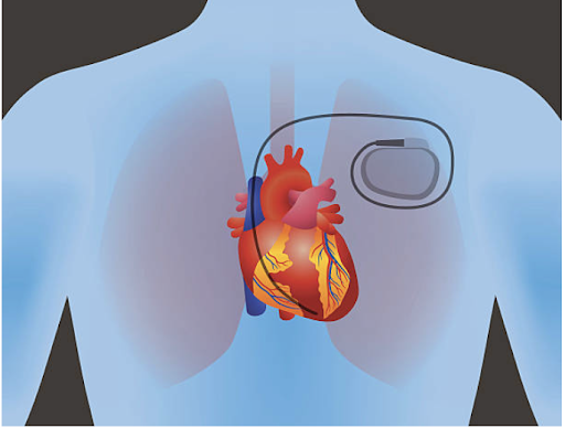 permanent-pacemaker-procedure